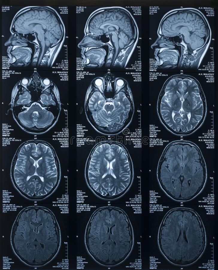Single MRI scan promises to diagnose early- and late-stage Alzheimer’s